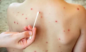 Lee más sobre el artículo Confirman caso de sarampión en SJR; suman 24 contagios en Querétaro